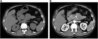 First case report of diagnosis of extrapancreatic solid pseudopapillary tumor with SMA invasion in a 47-year-old man: a case report and literature review